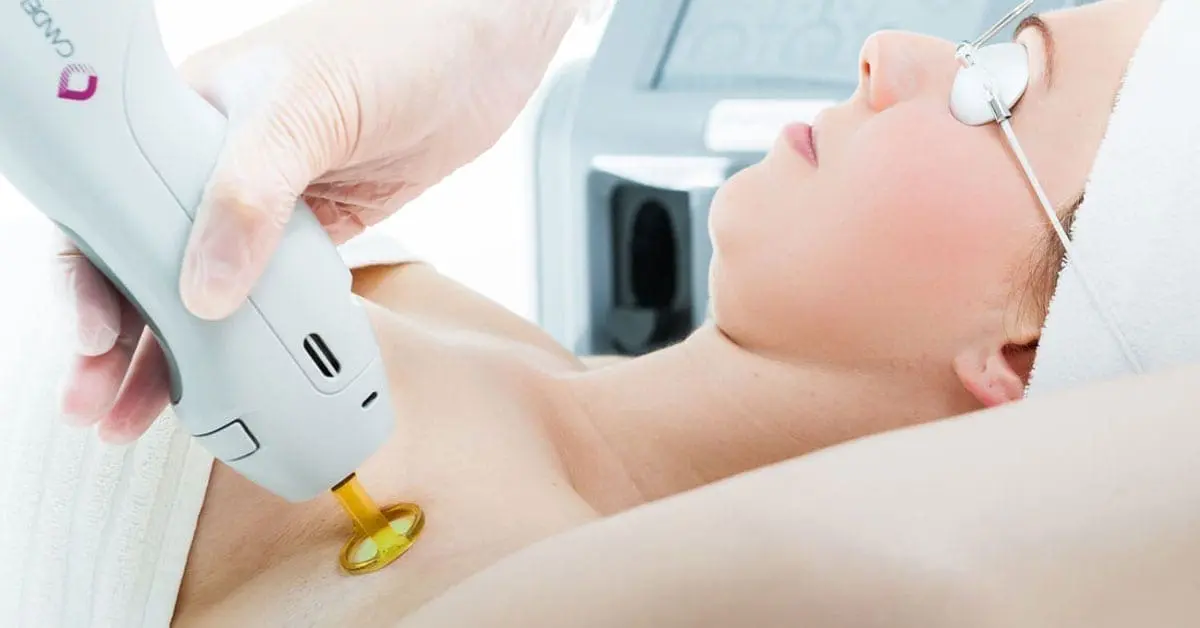 Candela laser hair removal near miami-dade county