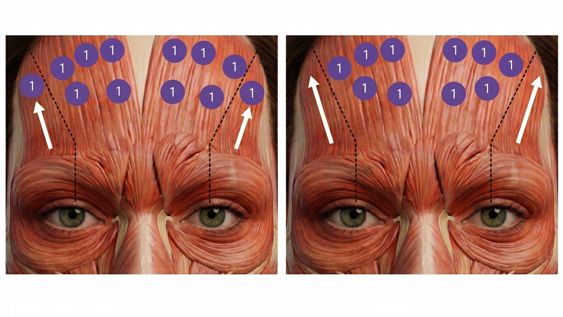 Forehead botox injection sites with numbered dosing points and directional arrows