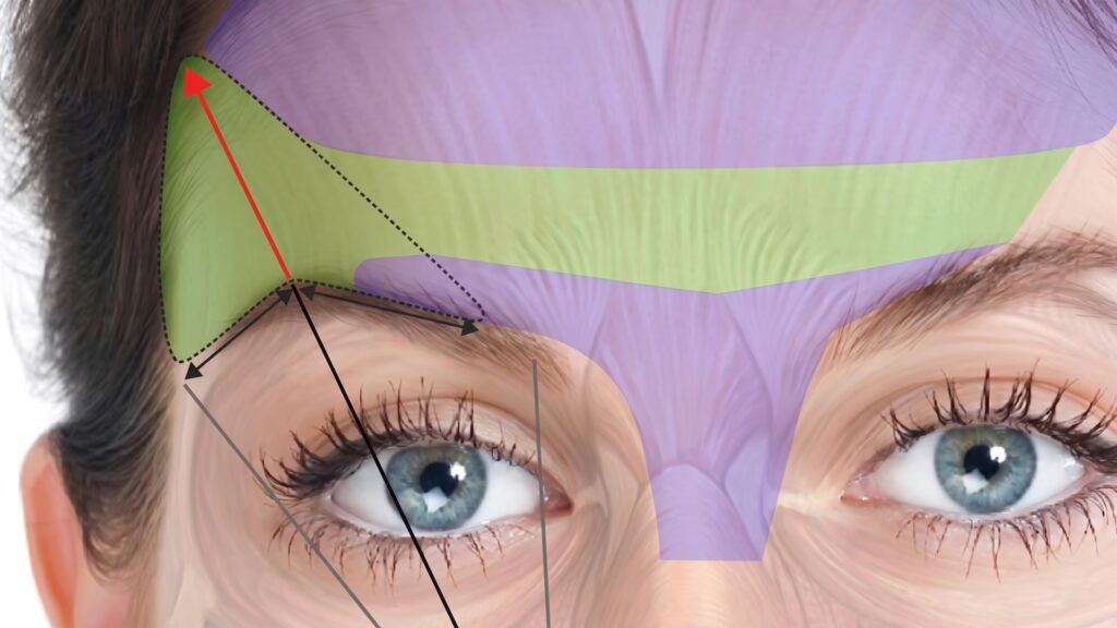 Brow-lift botox muscle mapping of the frontalis and orbicularis around the eyes