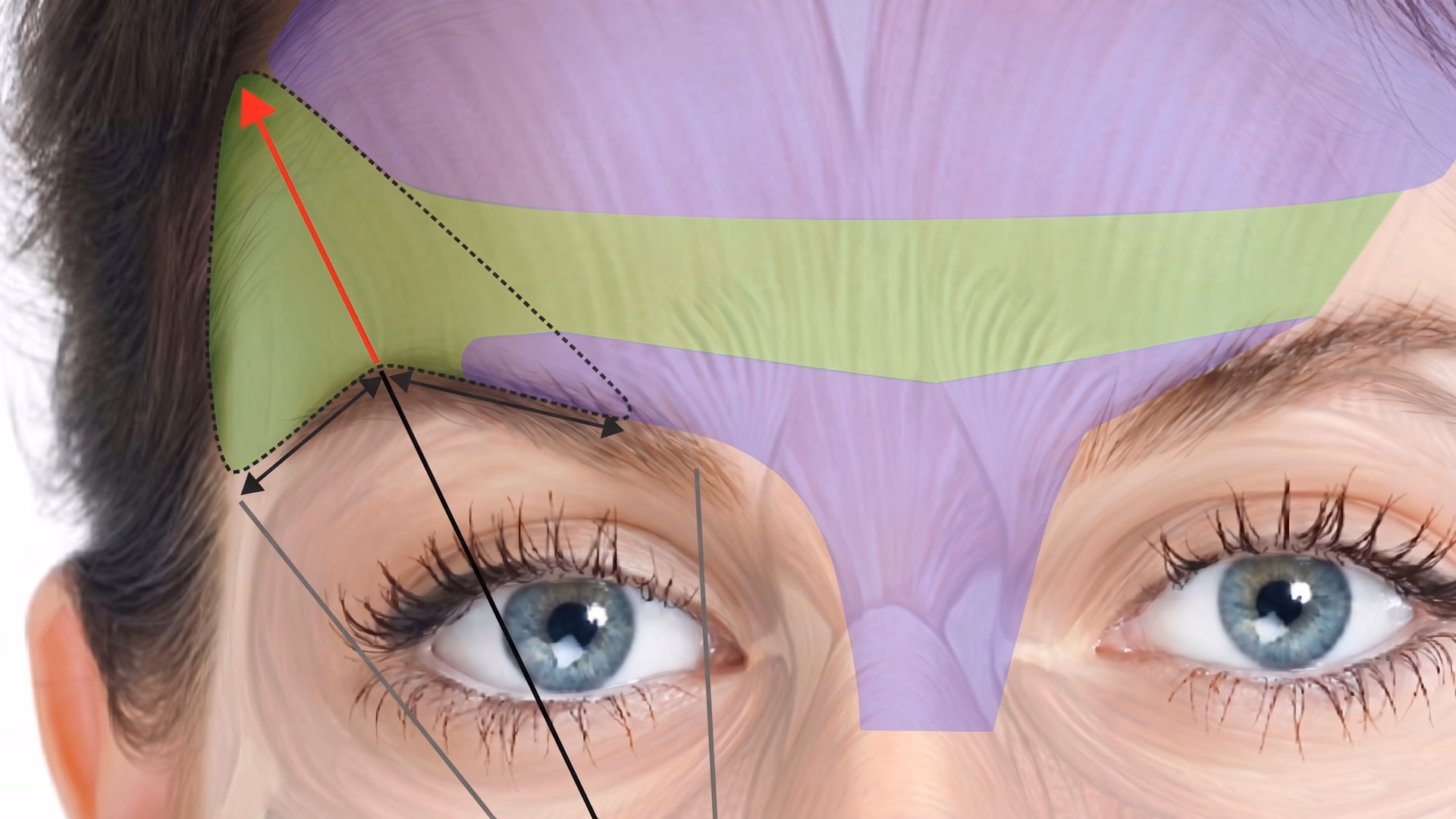 Brow-lift botox muscle mapping of the frontalis and orbicularis around the eyes