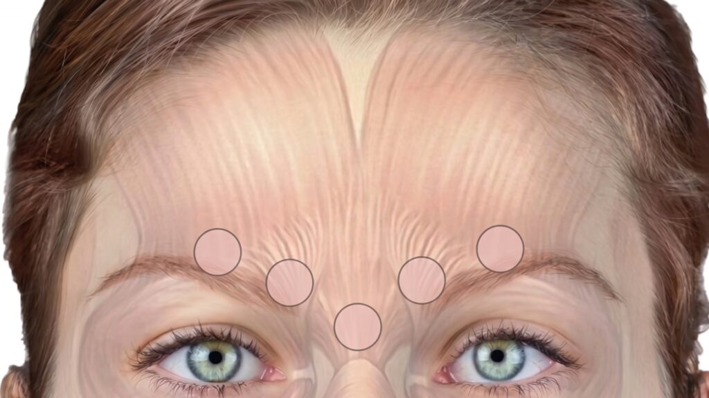 Glabella frown-line injection mapping with marked botox treatment points